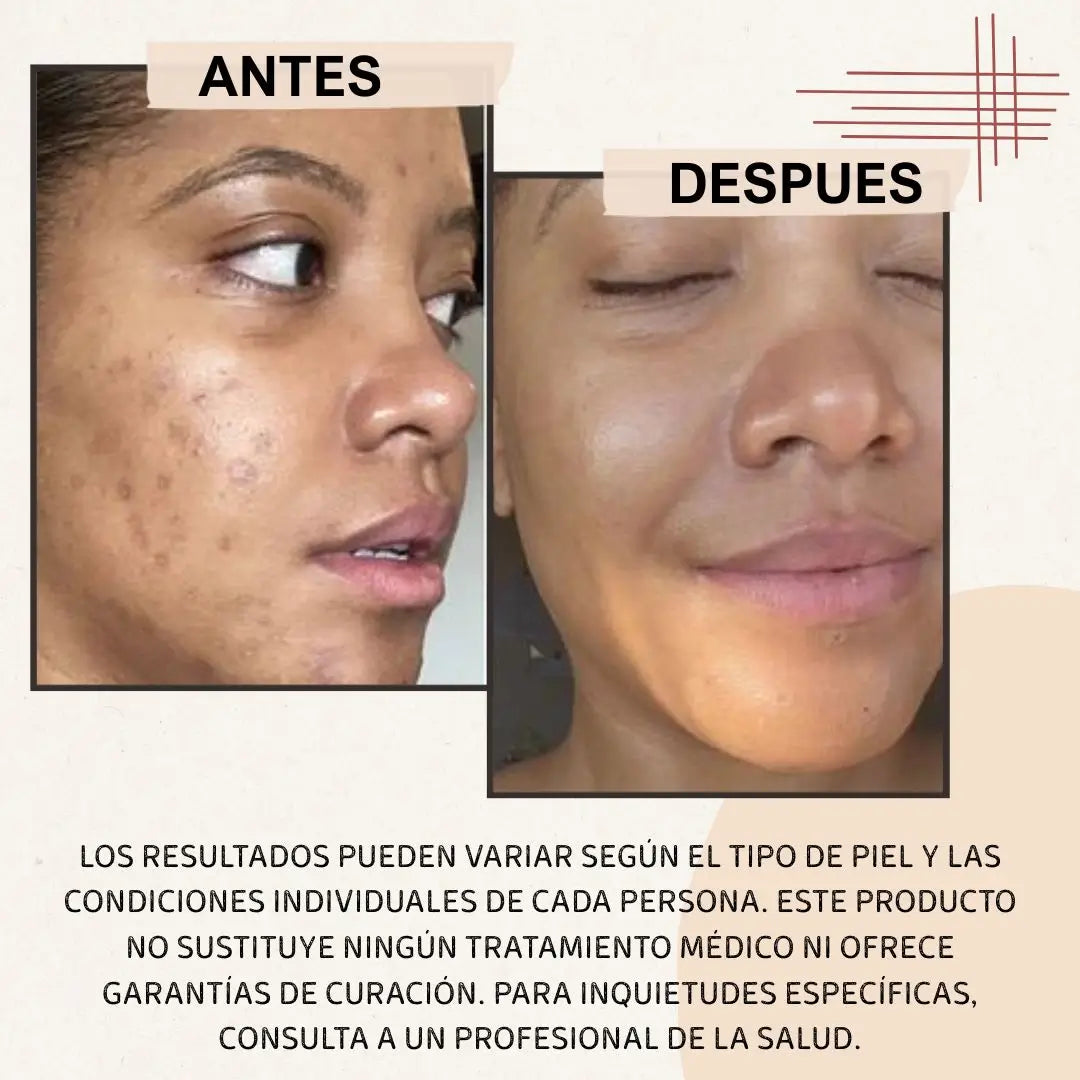144 Parches Hidrocoloide Para Acne®