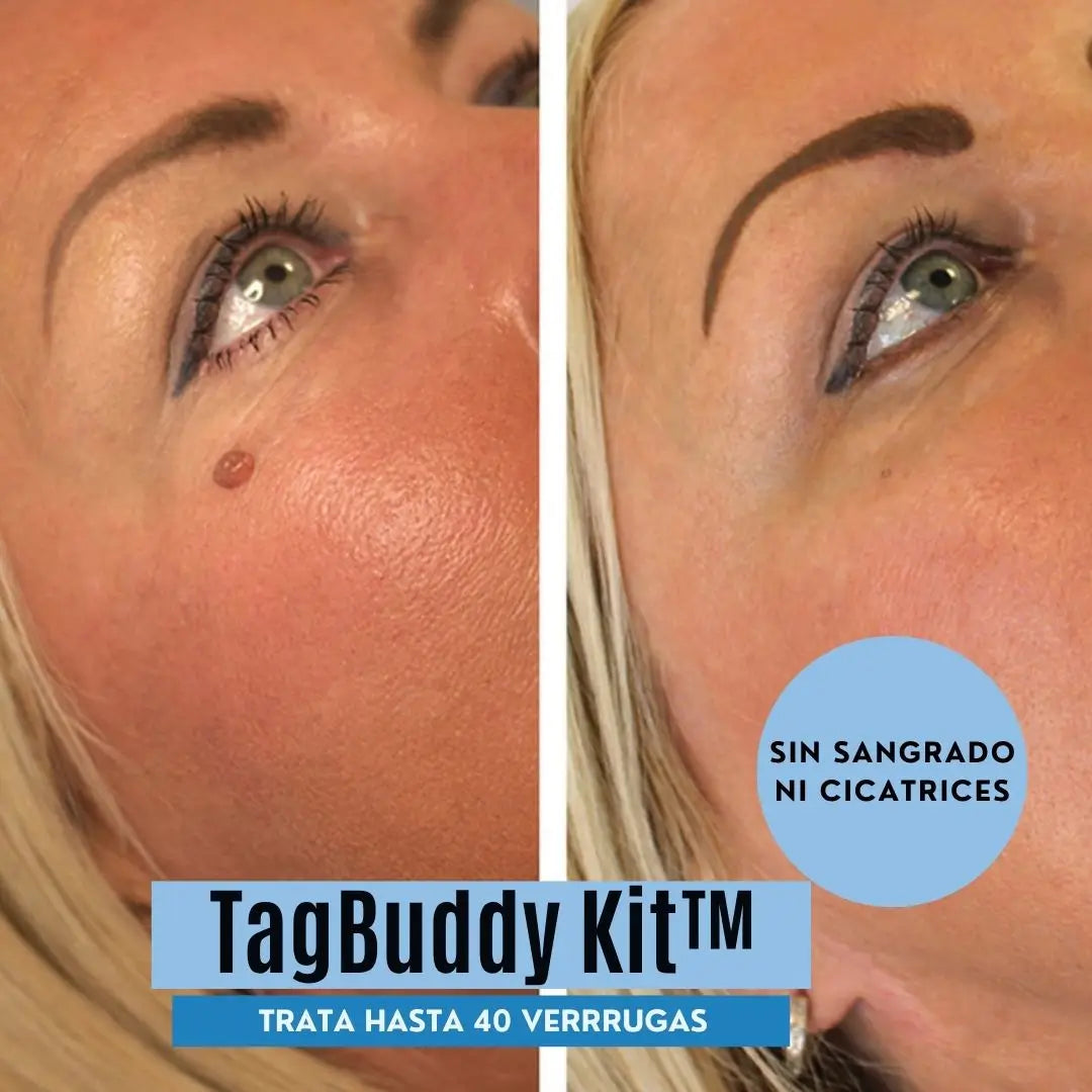 Kit TagBuddy: No más verrugas en la piel