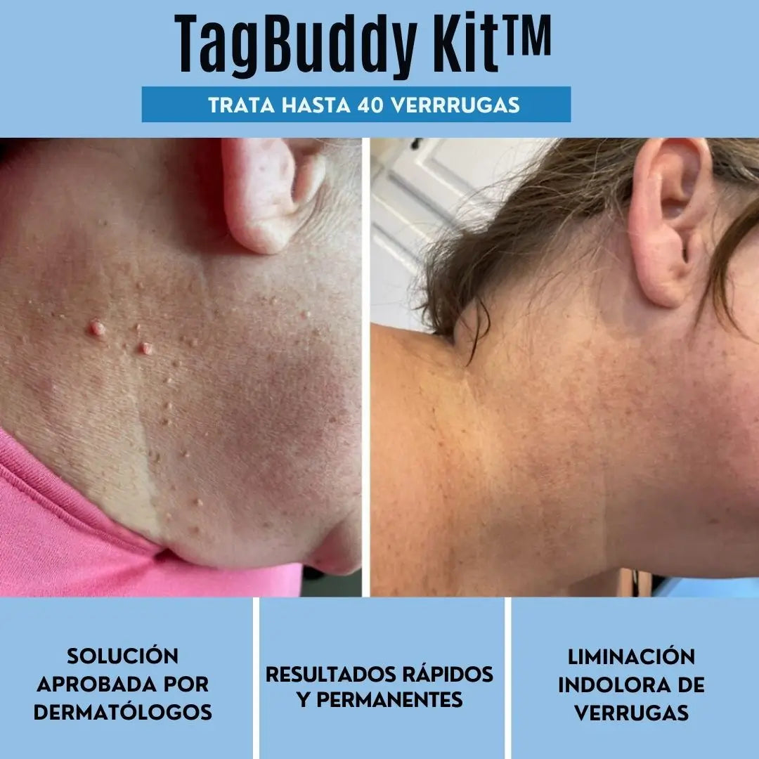 Kit TagBuddy: No más verrugas en la piel