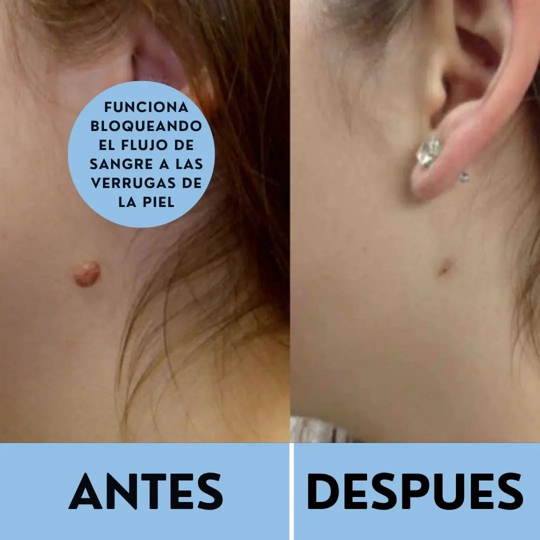 Kit TagBuddy: No más verrugas en la piel