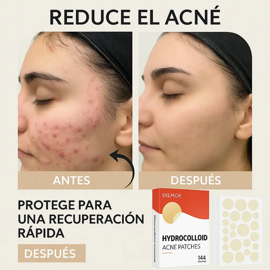 144 Parches Hidrocoloide Para Acne®